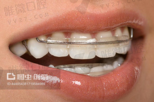 做假牙和种植牙区别大吗,哪些情况不适合种植牙(图1)